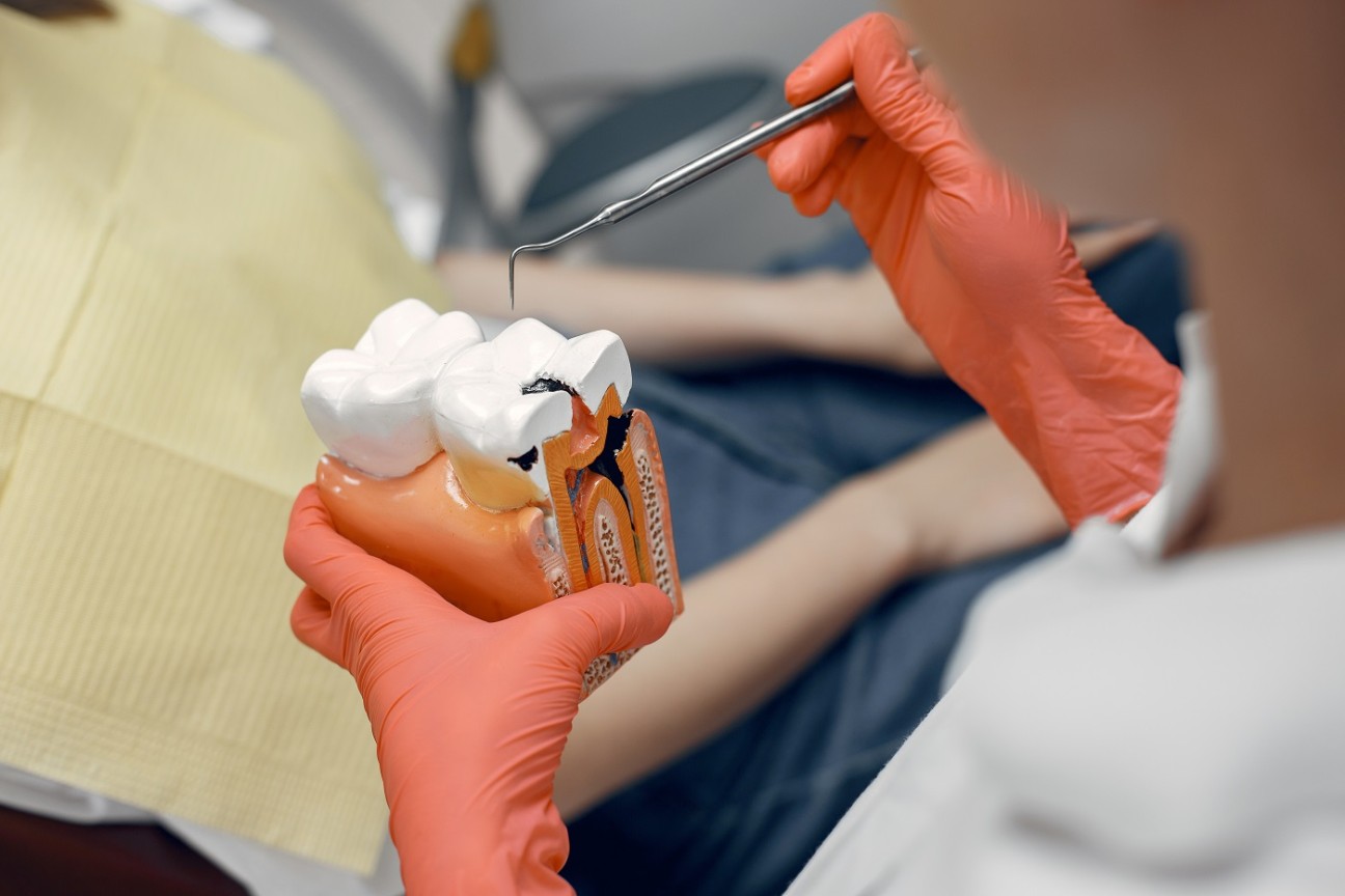 Caries Treatment